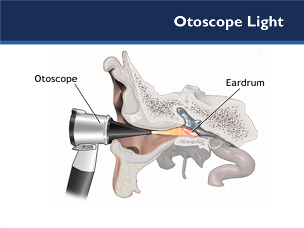 Picture showing an otoscope light shining at the eardrum.